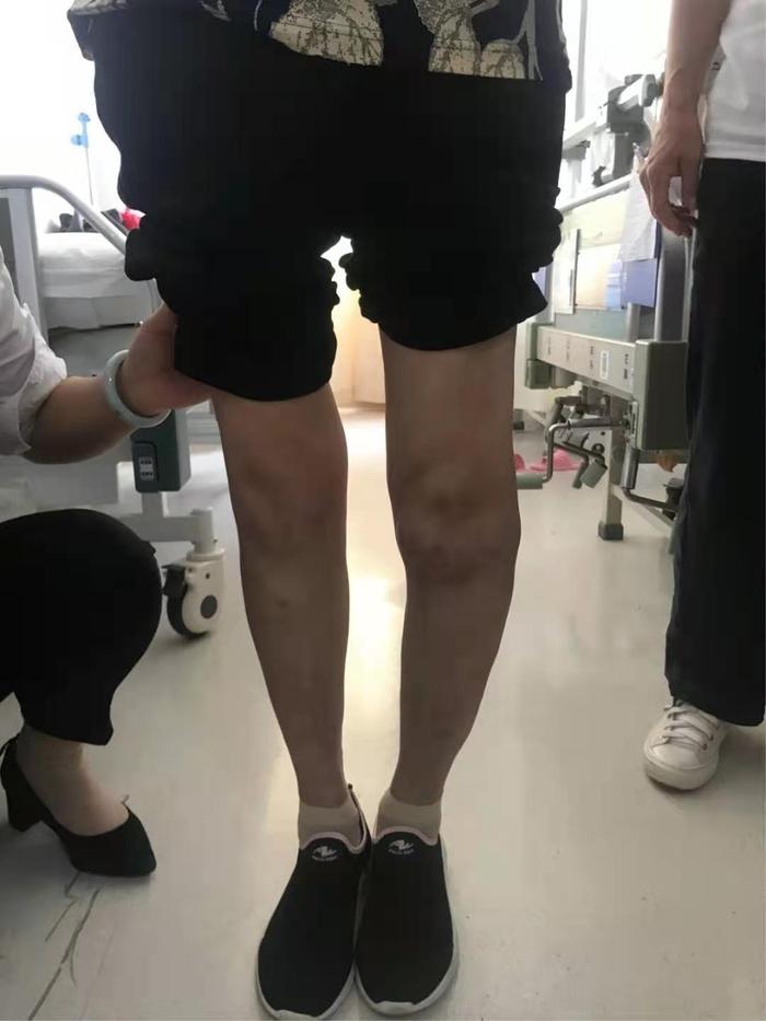 关节内翻畸形双下肢负重力线显示左膝关节内翻程度术中见双膝关节髌股