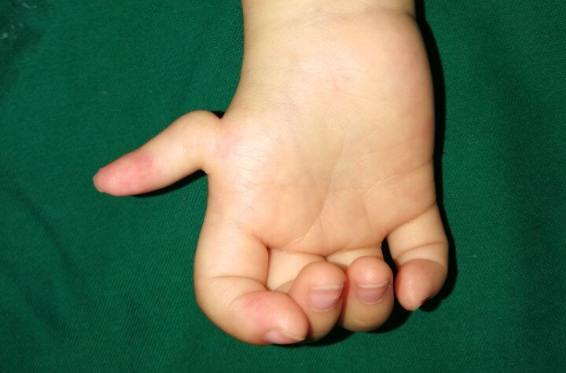 小儿三岁大拇指发育不良漂浮指能做掌骨移植重建手术吗