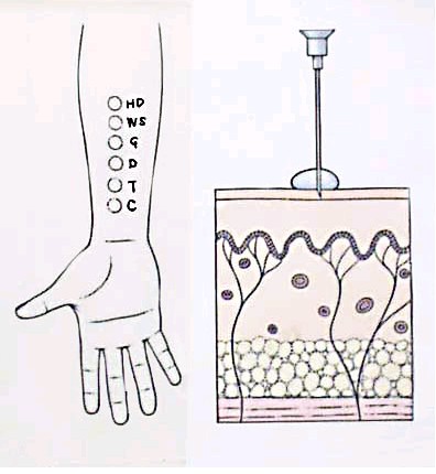 过敏原检测皮肤点刺试验图示