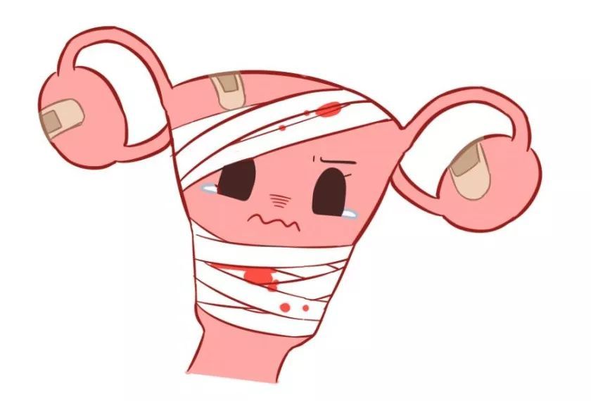 聚焦超声消融治疗子宫肌瘤后会形成瘢痕子宫吗