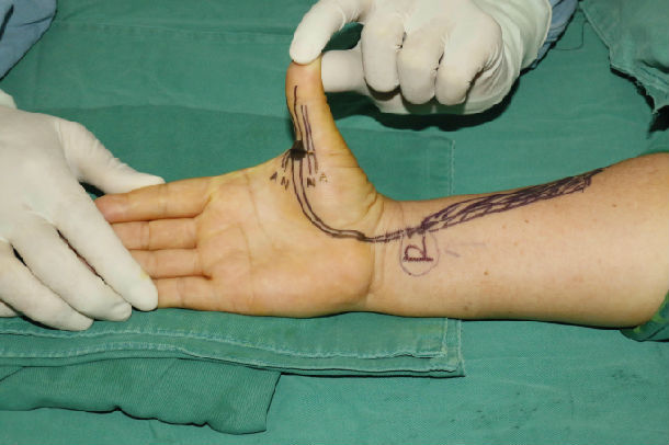 中指腱鞘炎手术图片图片