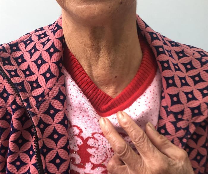 甲状腺腺瘤缩小病例