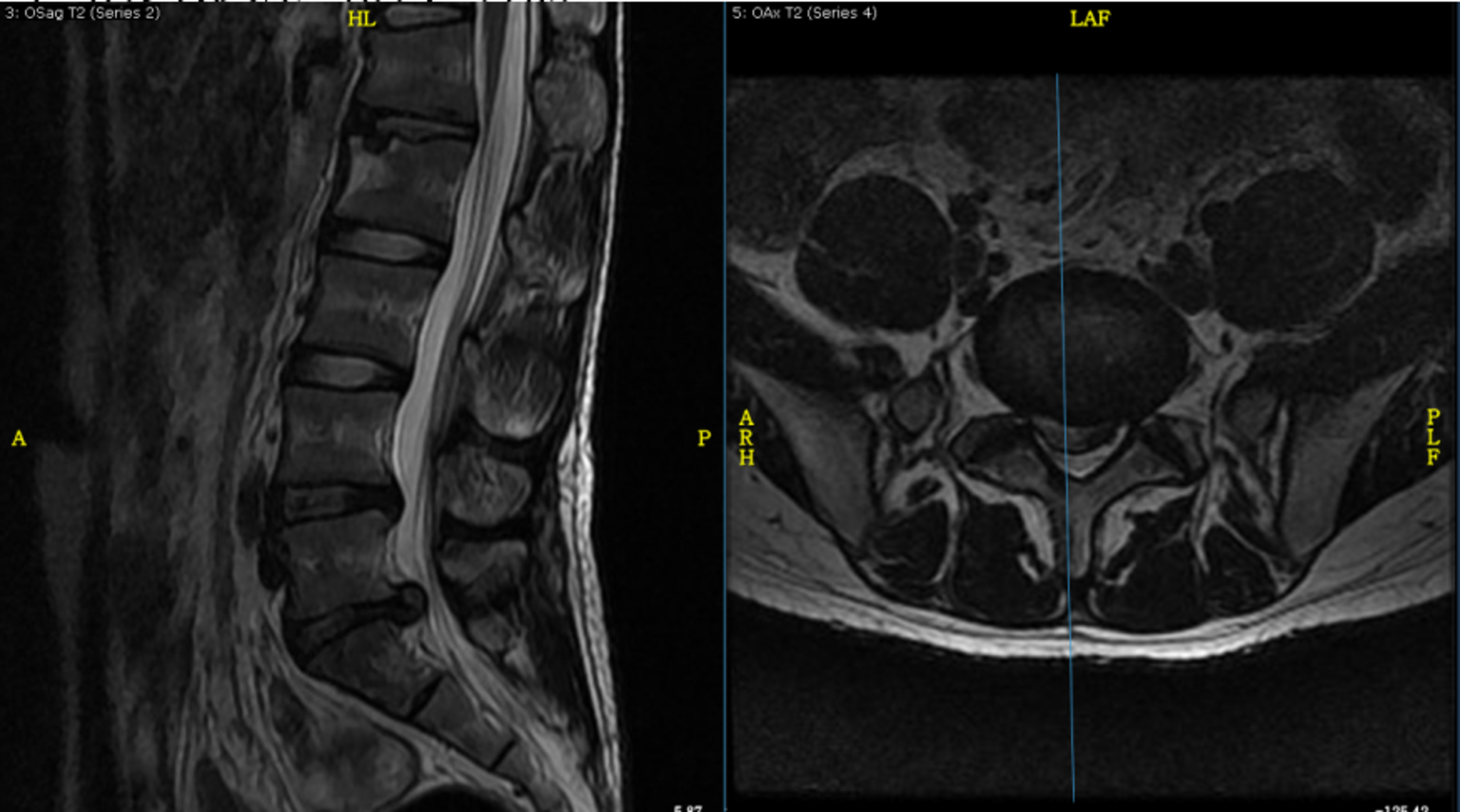 腰椎磁共振检查,显示l4/l5,l5/s1椎间盘突出,两个腰椎髓核脱出压迫到