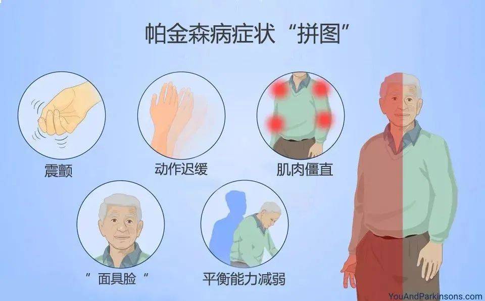 目前,运动症状仍是诊断帕金森病的主要门槛,也是帕金森病人必有的一条