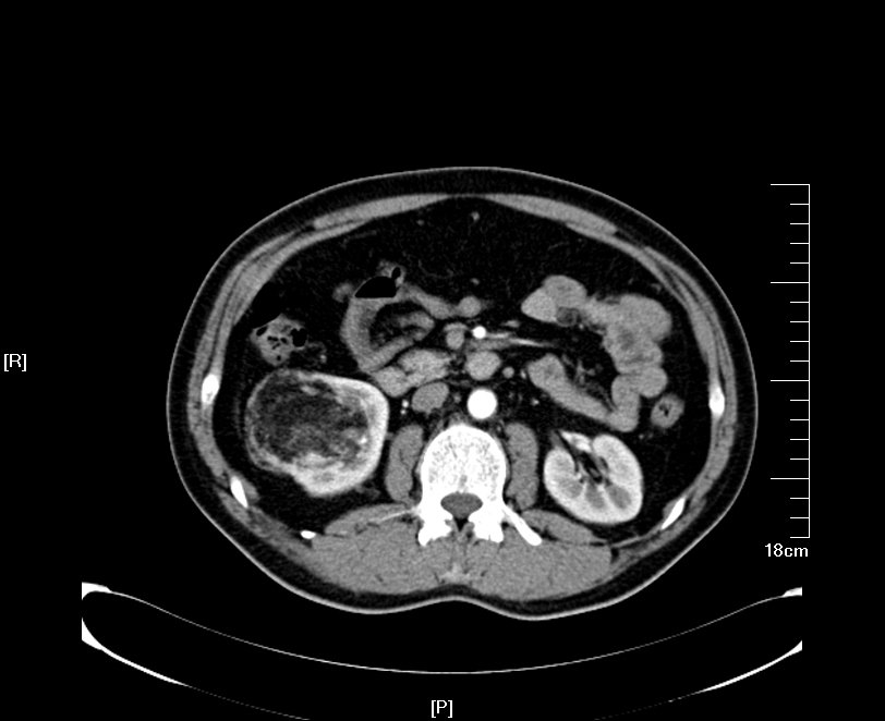 肾错构瘤的微创保肾治疗