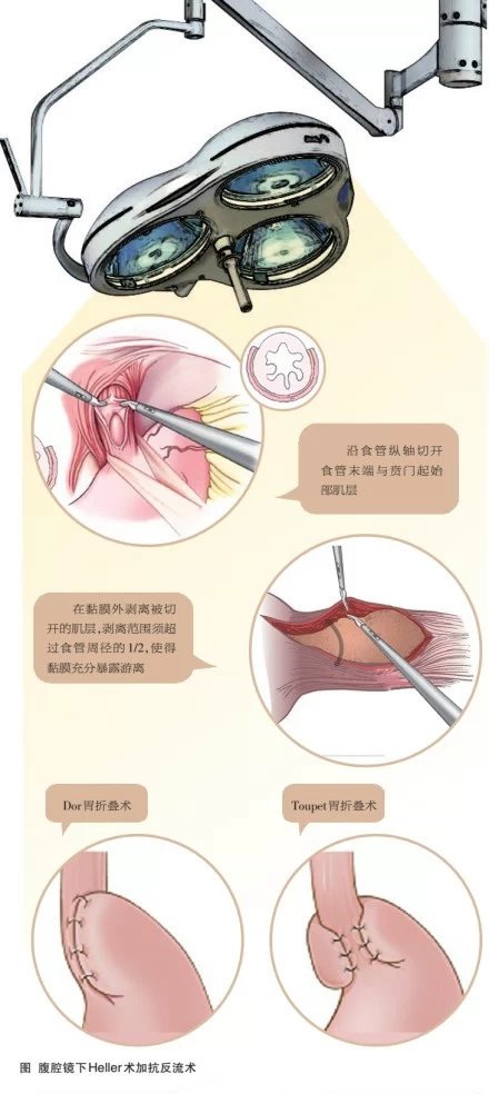 治疗贲门失弛缓症的经典外科术式