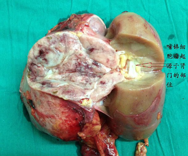 一例与肾脏相连的巨大嗜铬细胞瘤