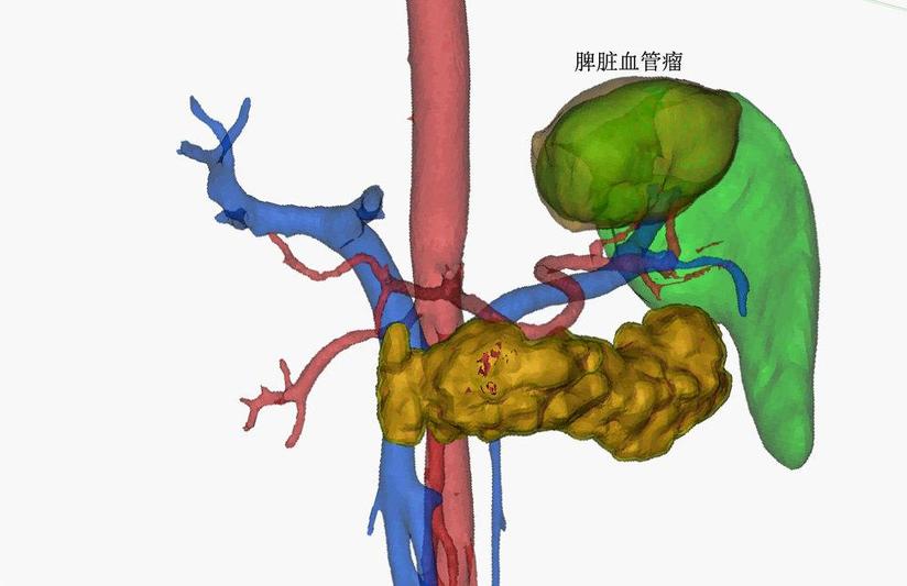 脾脏良性肿瘤或低度恶性肿瘤必须切除整个脾脏吗 其实还可以选择保留功能的部分脾切除术 健康号 微医