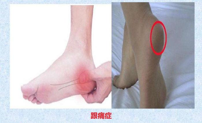 骨科医生带你了解足跟痛跟痛症