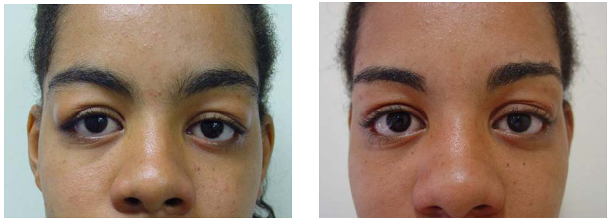 lacrimal gland prolapse: management during aesthetic