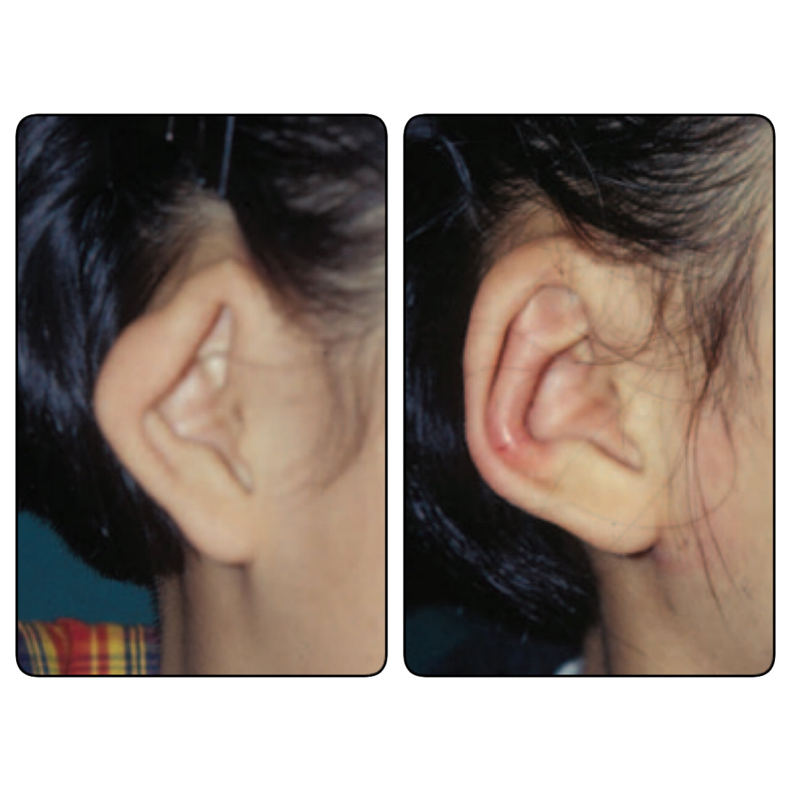 杯状耳卷曲耳完美手术图解附案例八大处于晓波医生