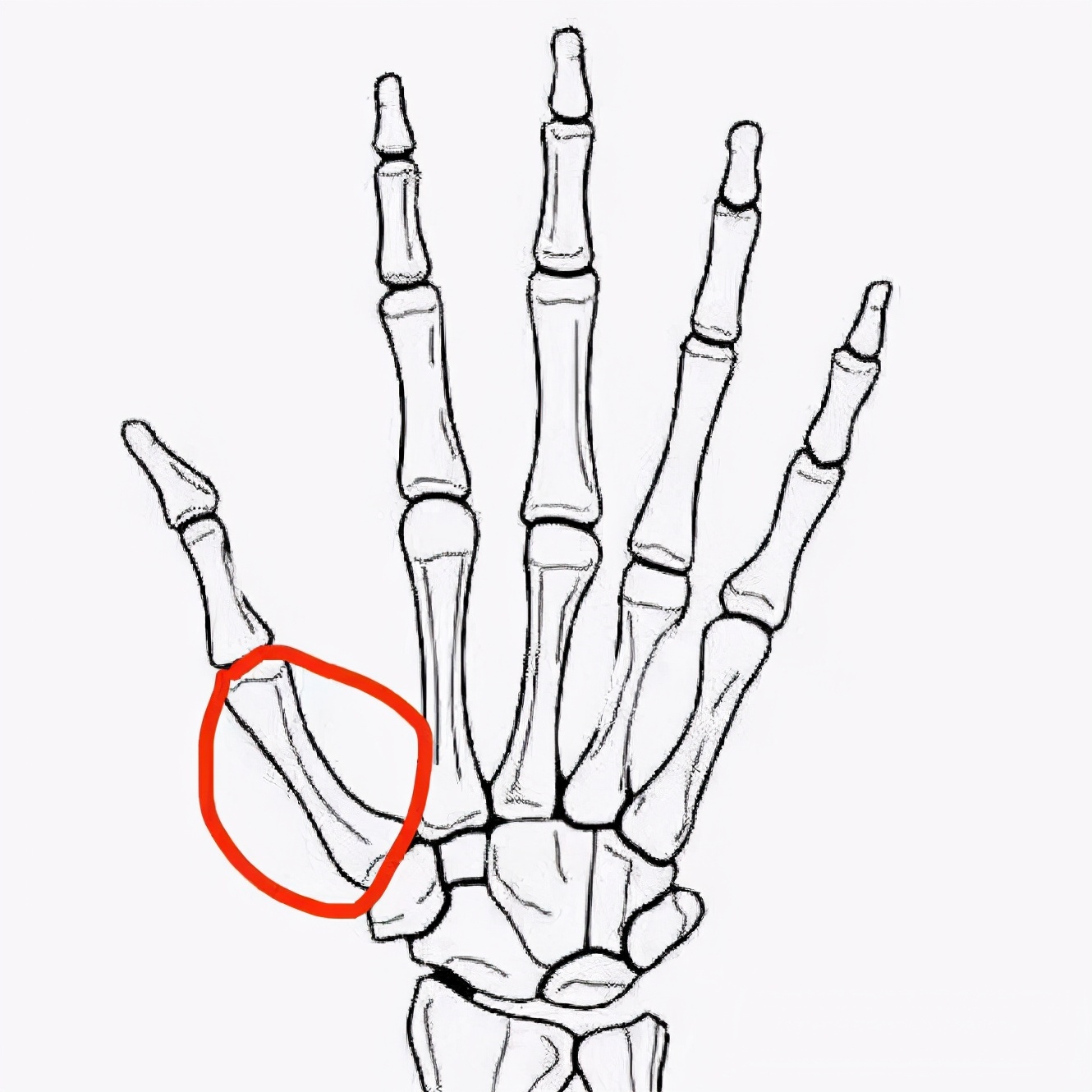 红色圈中的为第一掌骨,漂浮拇患者缺失了这根骨头因为得了这种病的
