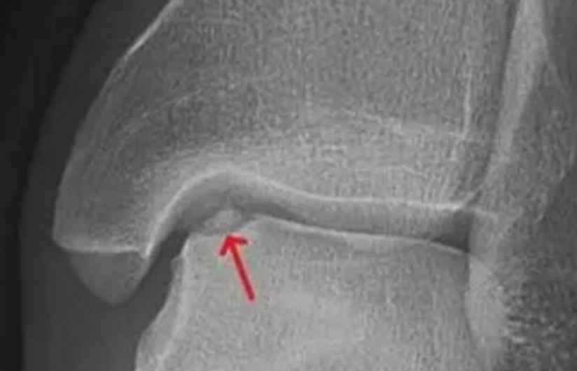 骨关节炎 了解距骨软骨损伤 健康号 微医