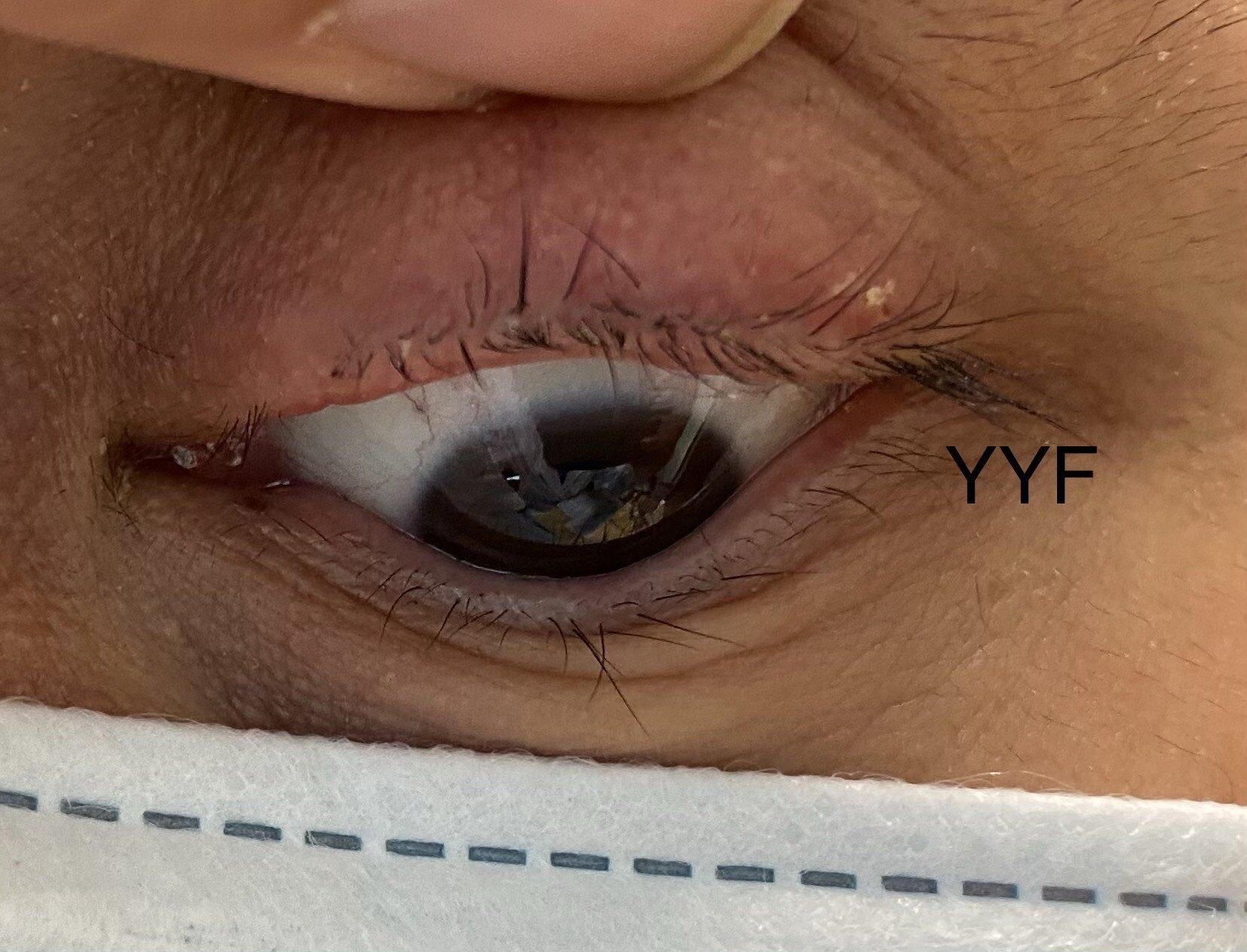 眼睑肿块系列之二睑缘霰粒肿手术宜早不宜迟