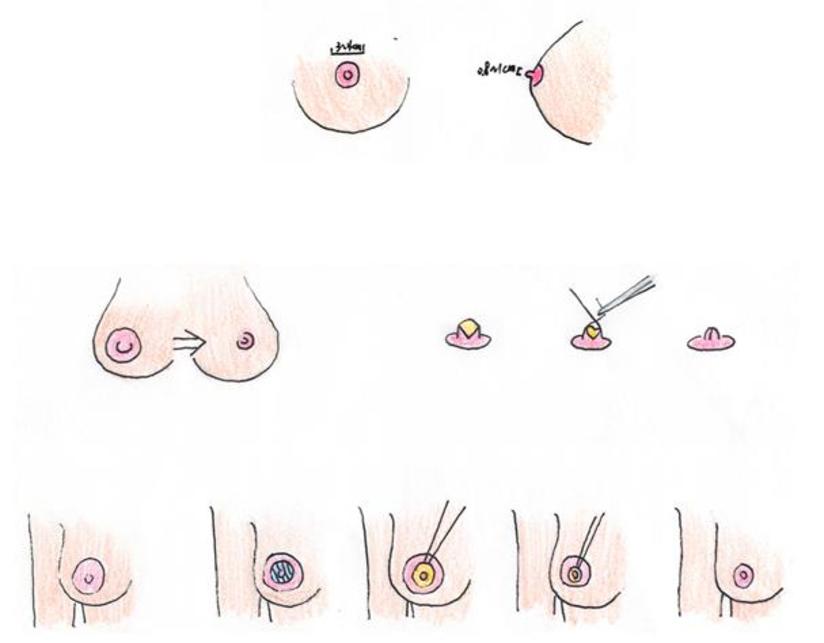 乳头乳晕整形必须知道的问题 健康号 微医