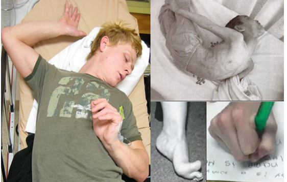 脑深部电刺激治疗肌张力障碍_方铁医生文章_北京儿童医院-微医