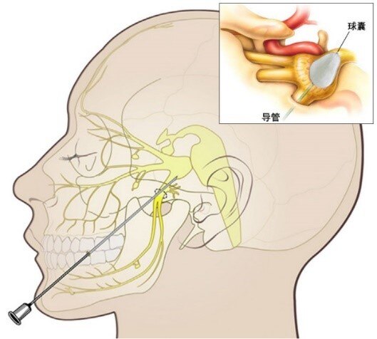 穿刺针从口角进针,达到三叉神经出颅腔的部位(卵圆孔),在x线辅助下将