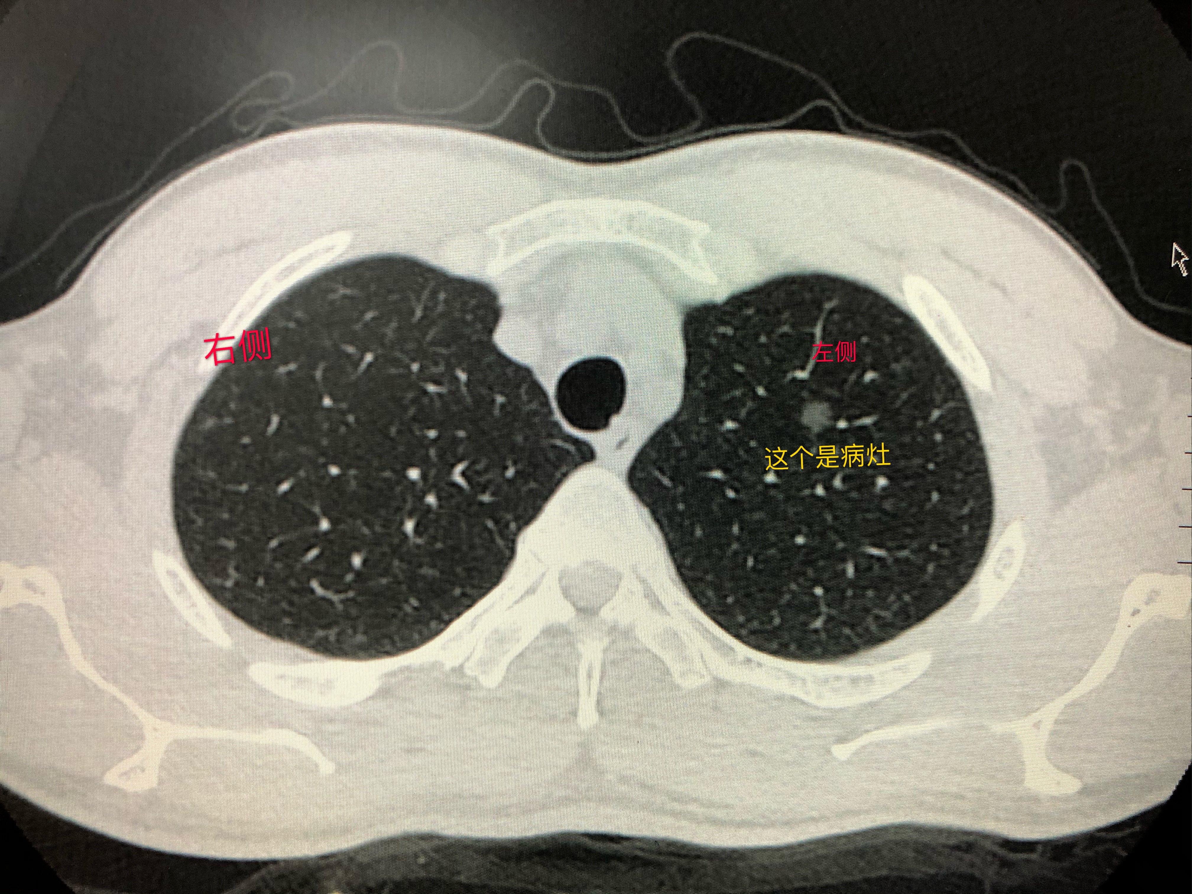 肺磨玻璃结节典型病例分享患者需要上传什么样的照片