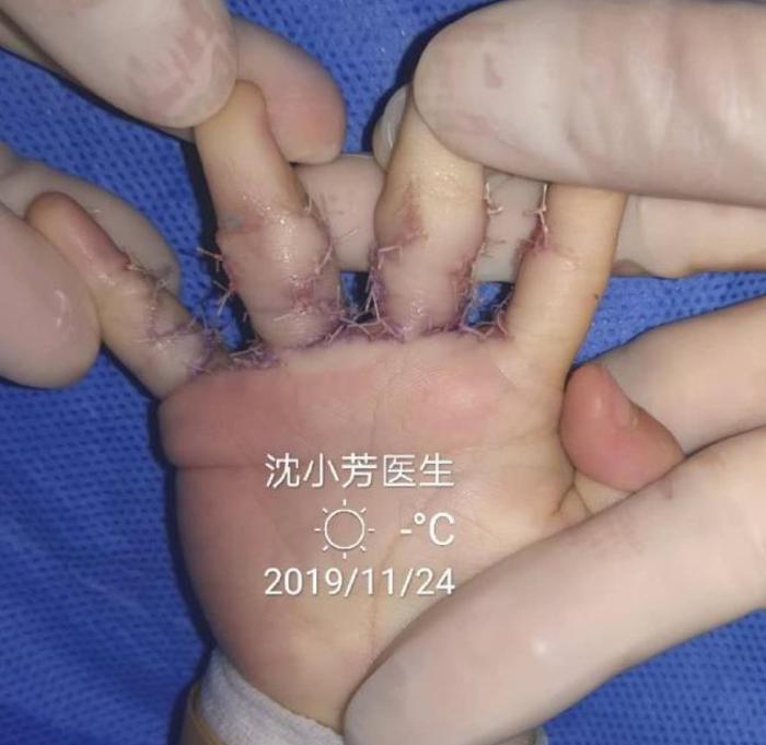 早期分离关节粘连以改善关节功能;结合再造,骨延长术改善手指长度