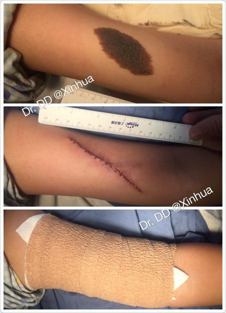 病例系列06几例手臂黑毛痣的治疗