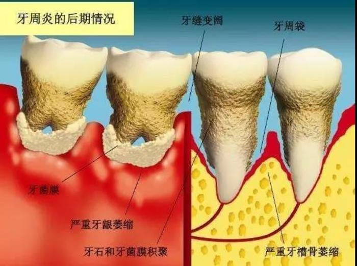 牙龈出血牙缝变大口臭原因大揭秘