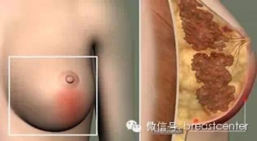 乳房突然红肿痛打针无效反复流脓怎么办 非哺乳期乳腺炎 健康号 微医