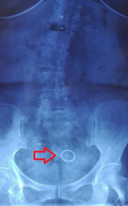 有金属节育环的椎间盘突出患者到底能不能做核磁共振