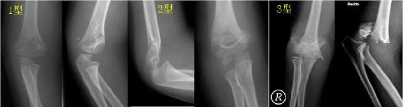 儿童肱骨髁上骨折 父母需要知道的事情 健康号 微医