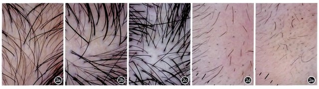 毛发疾病皮肤镜诊断