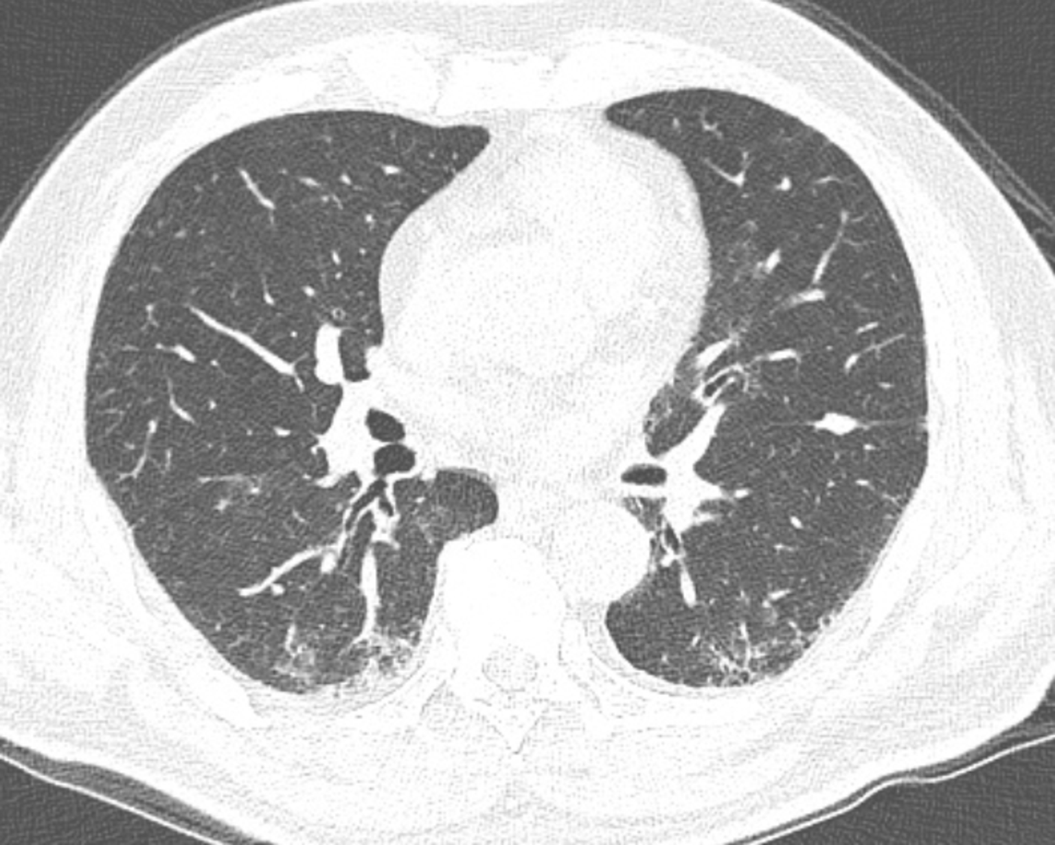 看图说肺肺内淋巴结