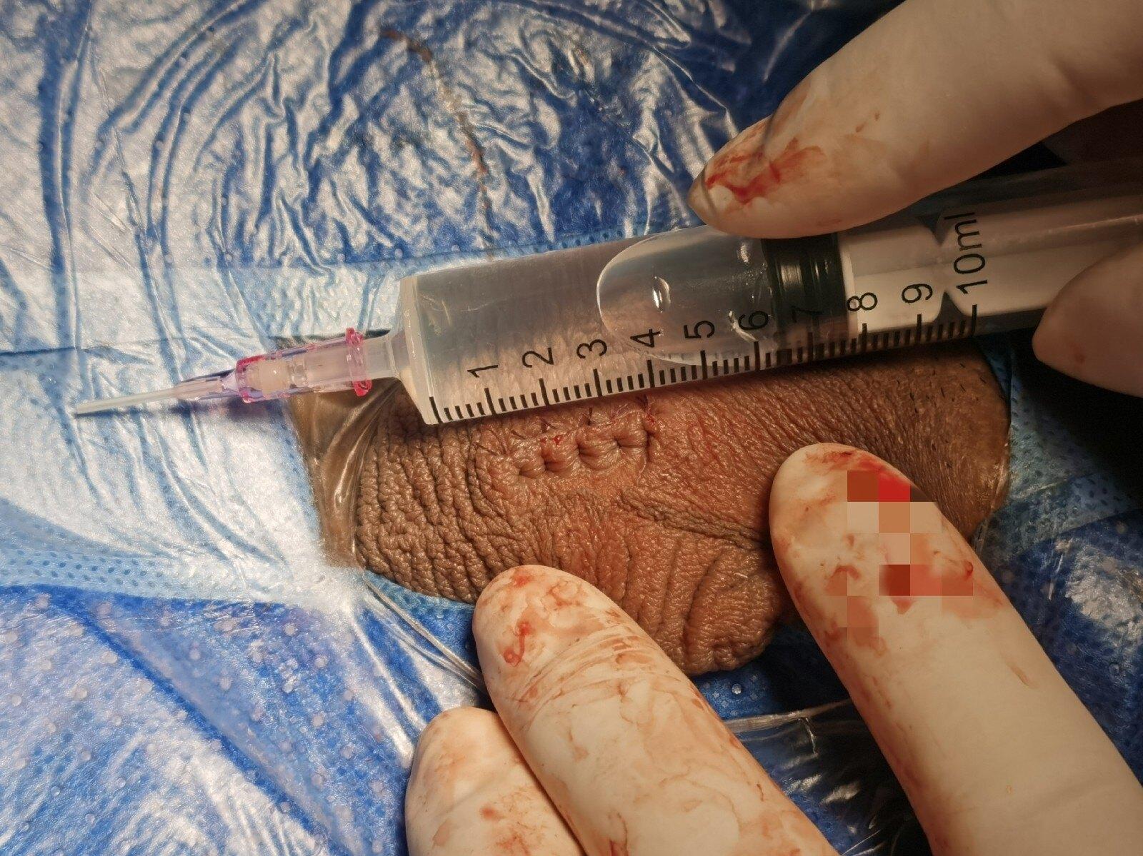 持续更新2020年11月显微取精的案例分享医者心语