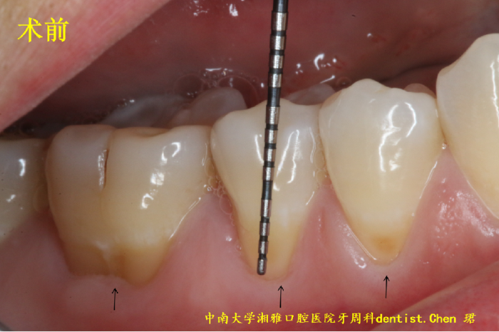 牙龈萎缩是不是只能任其发展如何预防和治疗牙龈萎缩