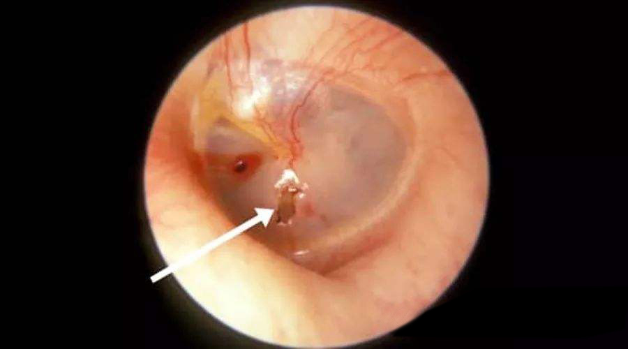 外伤后的耳膜损伤会自愈吗