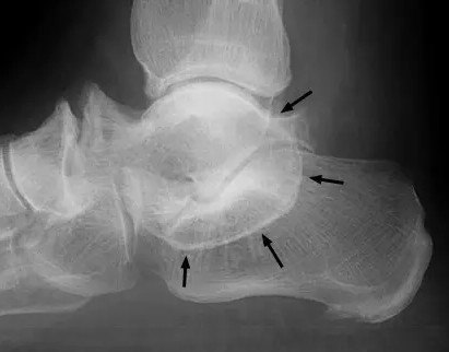跟距骨桥的微创治疗(关节镜下切除术) - 微医(挂号网)