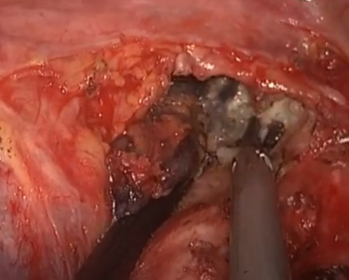 看图说肺——胸腔内的淋巴结