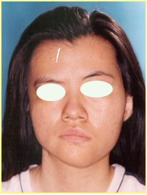 髁突高位切除术结合正畸治疗髁突肥大