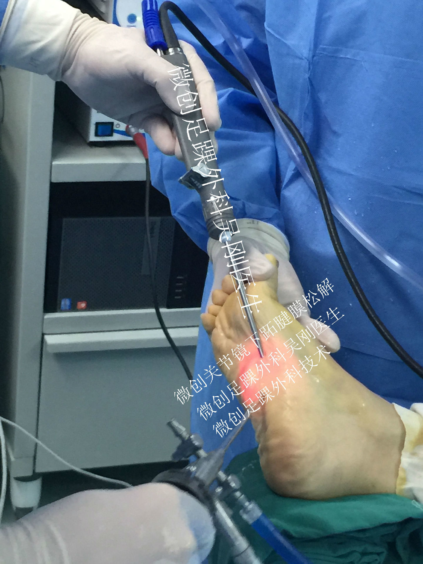 微创足踝外科特色之三关节镜下治疗跖腱膜挛缩