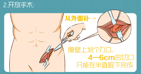 腹腔镜微创手术帮您摆脱疝病困扰