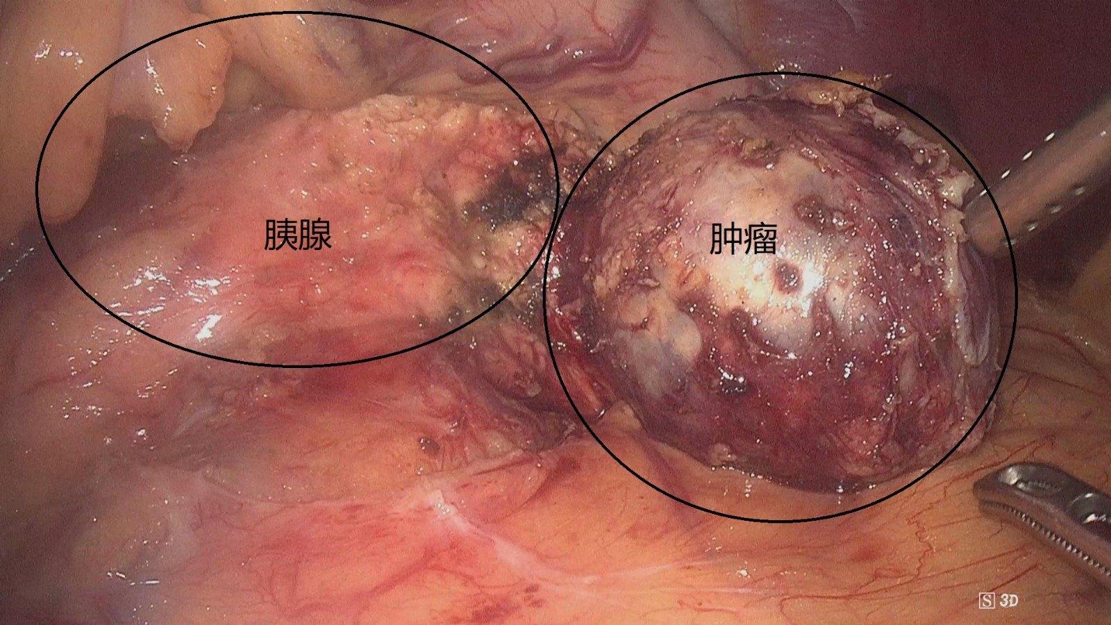 腹腔镜保留功能的胰腺肿瘤局部切除术是胰腺低度恶性肿瘤患者的最好