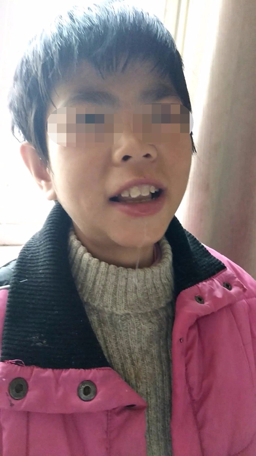 脑瘫孩子流口水说话不清如何治疗