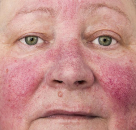 想要肝病不敢"找上门",教你"3招",清肝脂,解肝毒-微医