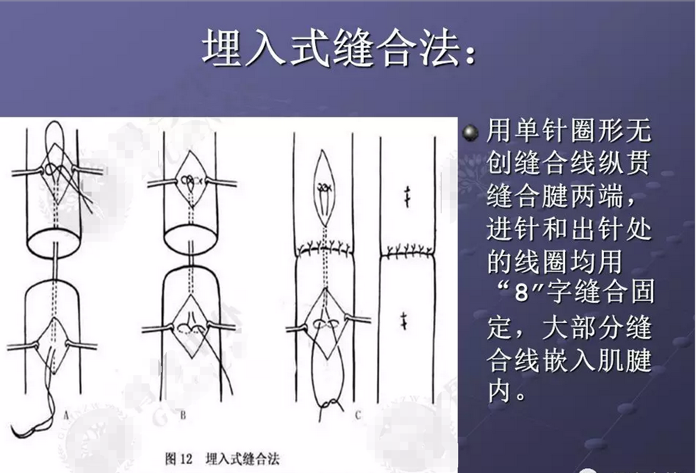 【肌腱/韧带损伤】肌腱缝合的原则和方法汇总 - 微医(挂号网)