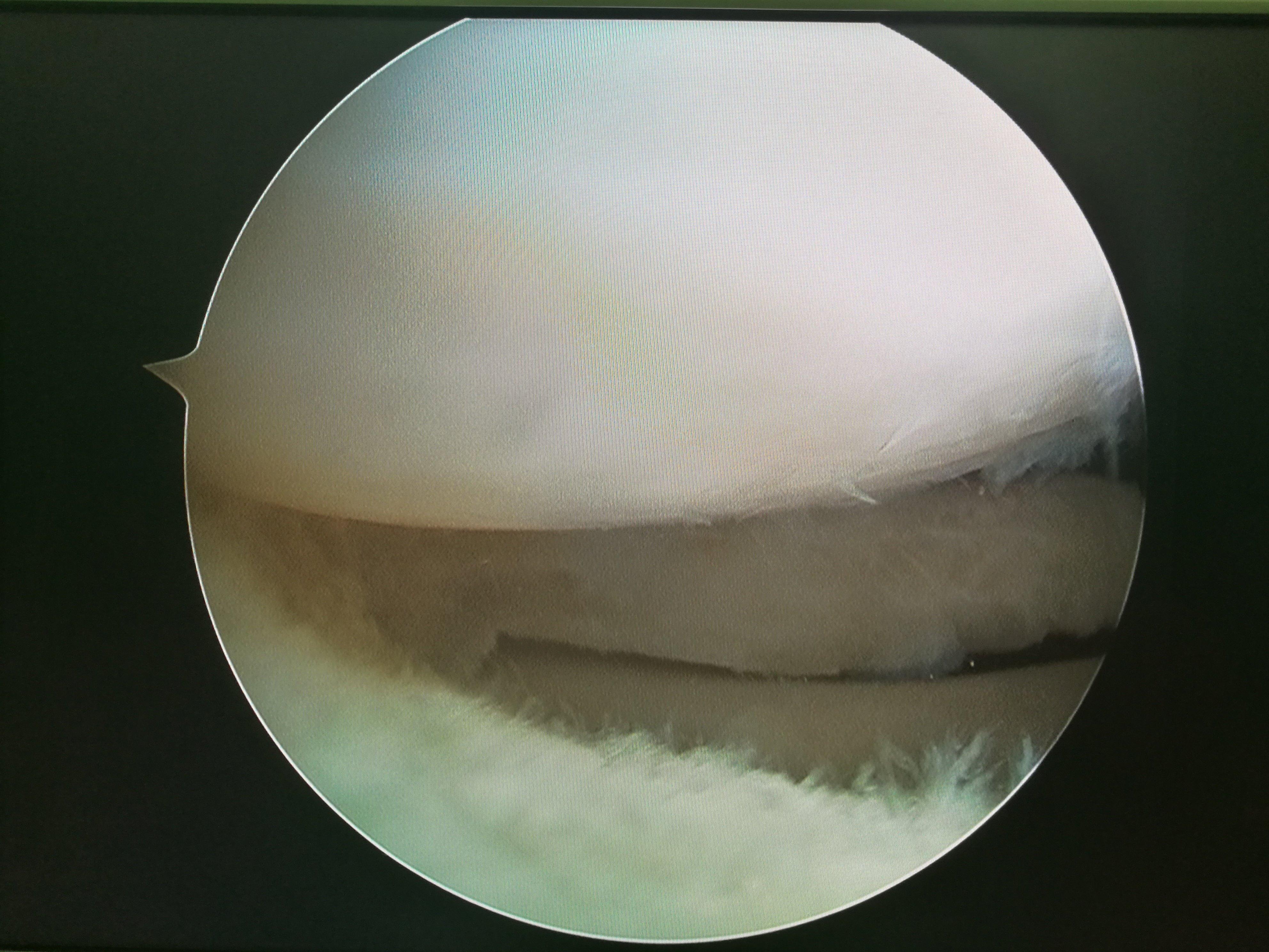 16岁女孩儿膝关节盘状半月板关节镜下成形术