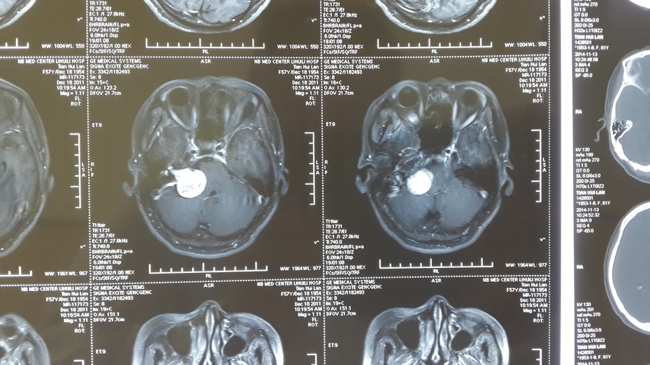 贺晓生教授听神经瘤术后四年追踪