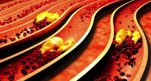 人过40最怕血管堵尽量少吃2种食物避免给血管添堵