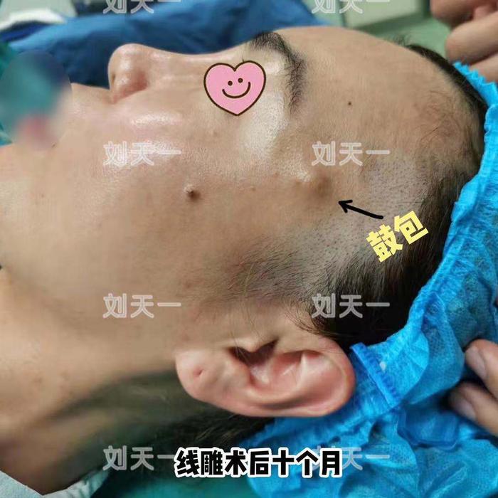 线雕术后常见的并发症鼓包硬结如何处理