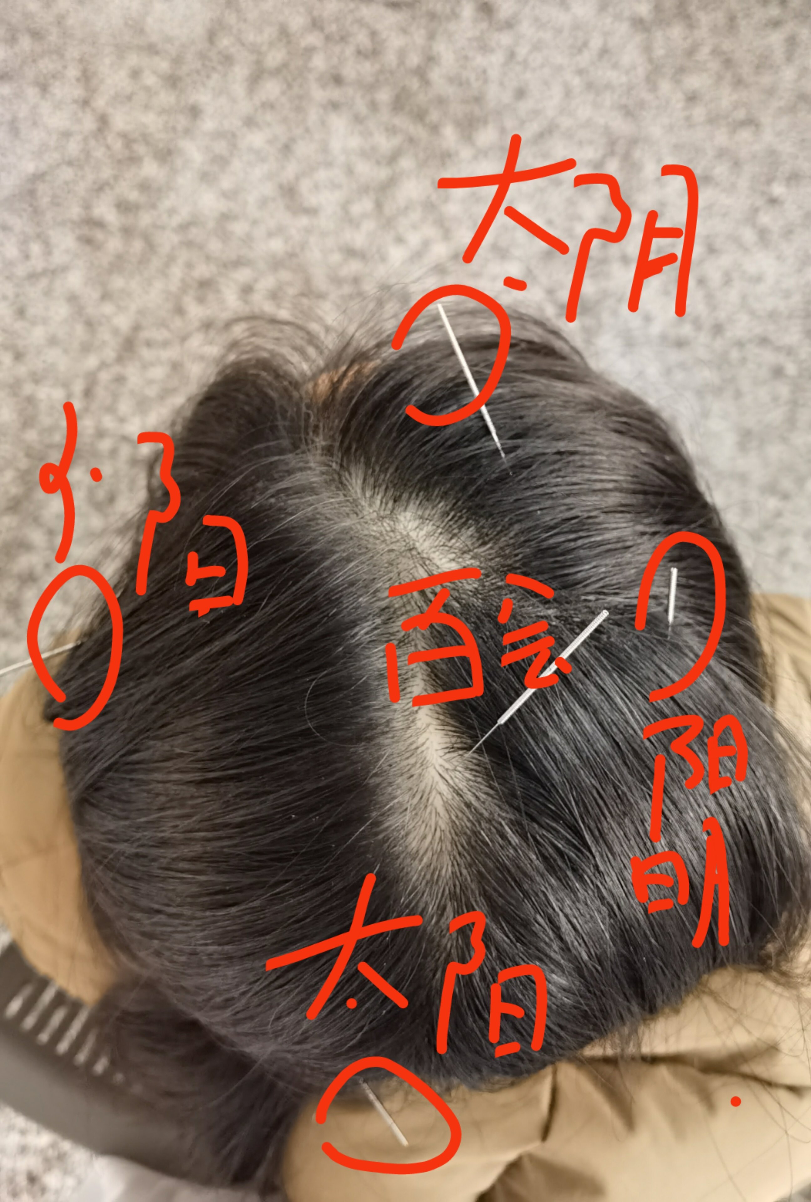 开阖枢六气针法治疗双手胀麻一例