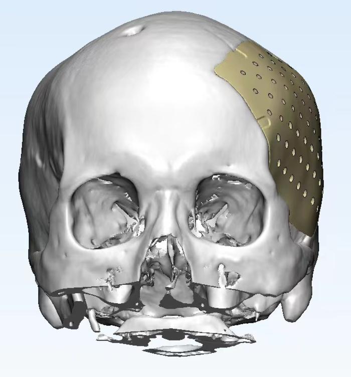 聚醚醚酮peek颅骨修补手术的典型病例手术操作规范并发症极低