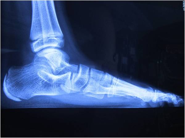 扁平足的微创治疗