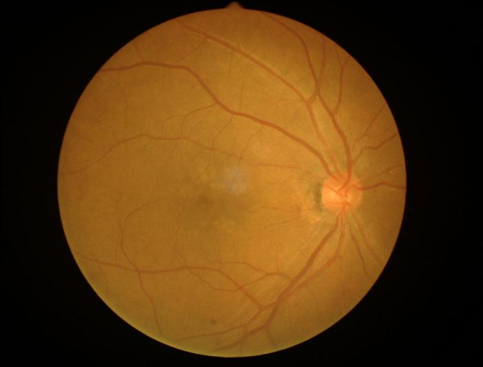 浅谈黄斑变性的诊断与治疗